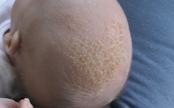 Cradle Cap
