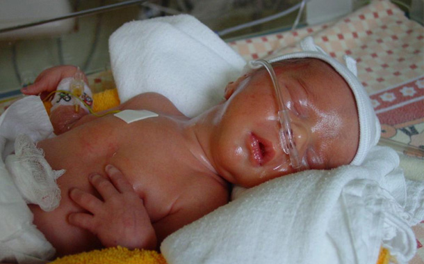 Premature Babies and Their Development