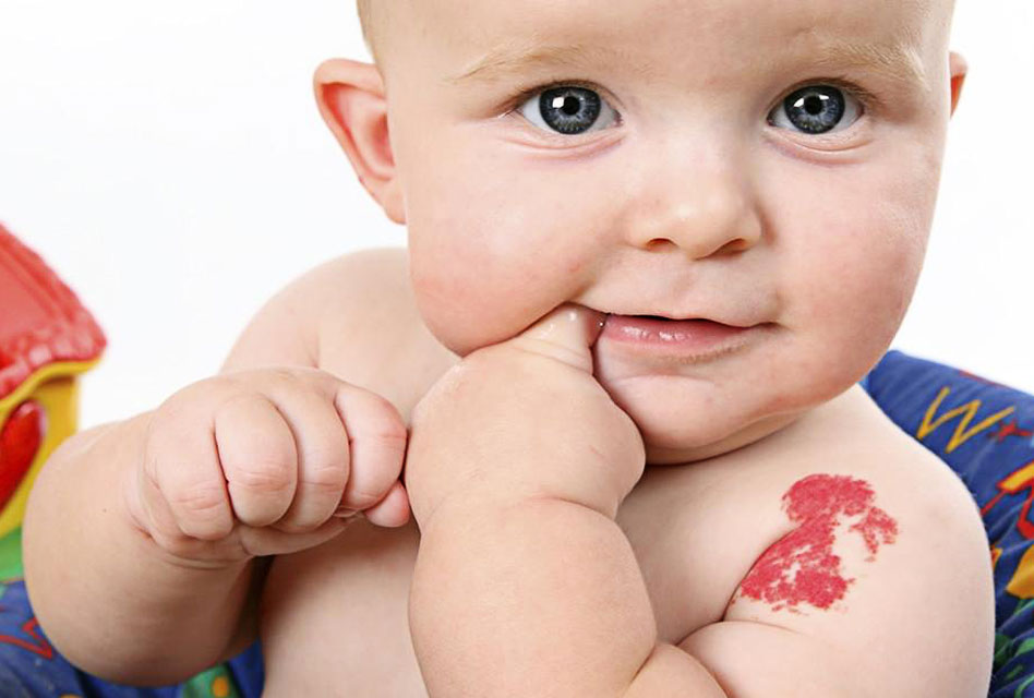 Birthmarks-1