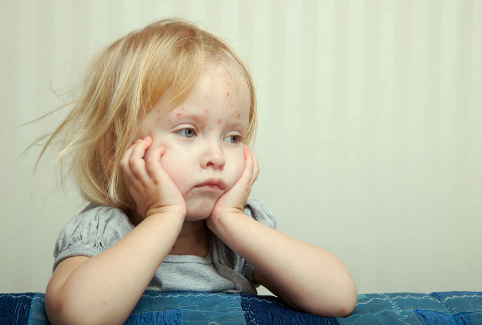 Rubella or German measles